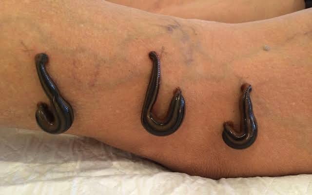 Leech therapy